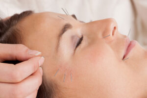 acupuncture-cupping-tcm-acupuncture-miami-acupuncture-infertility-miami-acupuncture-treatments