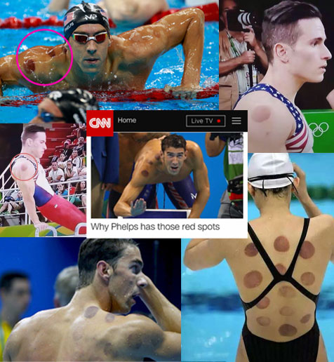 TCM-olympians-using-cupping