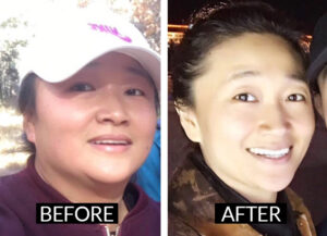 acupuncture-treatments-tcm-acupuncture-miami-benefits-results-body-lose weight