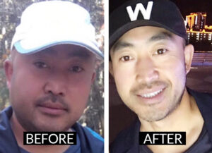 acupuncture-treatments-tcm-acupuncture-miami-benefits-results-body-lose weight